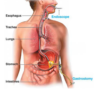 Dr Dewald Coolen Percutaneous Endoscopic Gastrostomy Peg Tube Dr Dewald Coolen